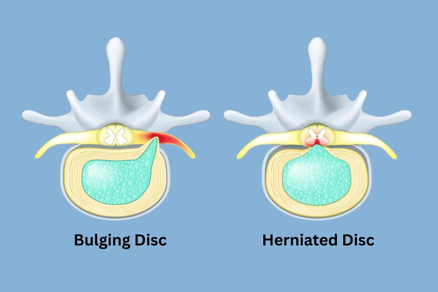 Complete Guide to Herniated Discs: Everything You Need to Know